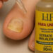 HF Pharma revela: Até 80% dos brasileiros podem ter micose nas unhas e a maioria nem desconfia